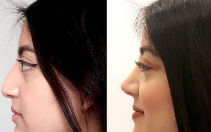 rinoplastia 2 meses despues de la intervencion
