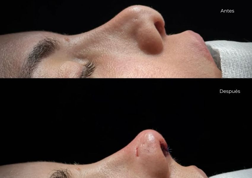 Rinoplastia secundaria nariz de loro Dr. Mis. Antes y después en quirófano