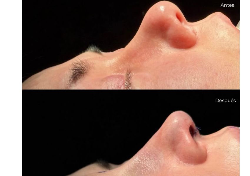 Rinoplastia secundaria nariz silla de montar. Dr. Mis. Antes y después